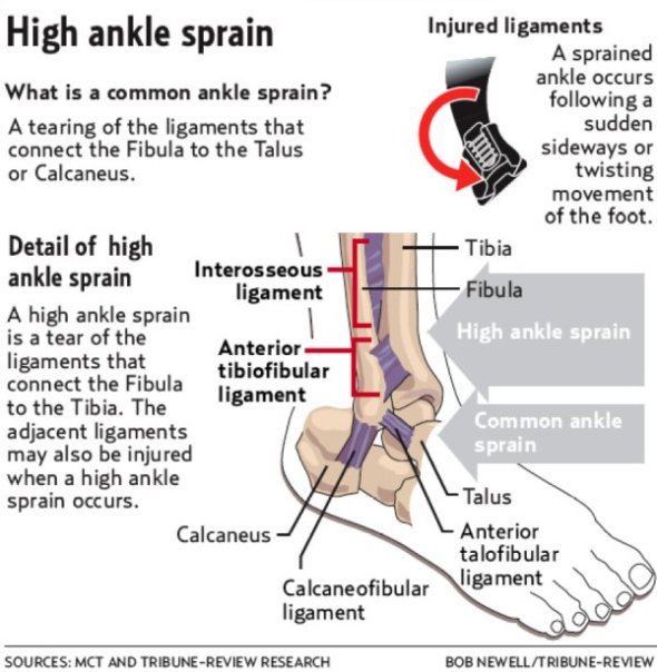 high_ankle_sprain