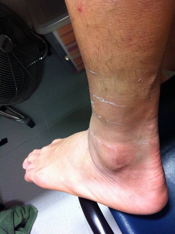 Taping up the ankle helps to keep it in place and prevent another inversion sprain. (Week 3 looking better) Taping up the ankle helps to keep it in place and prevent another inversion sprain. (Week 3 looking better)